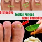 Antifungal Toenail Home Remedies